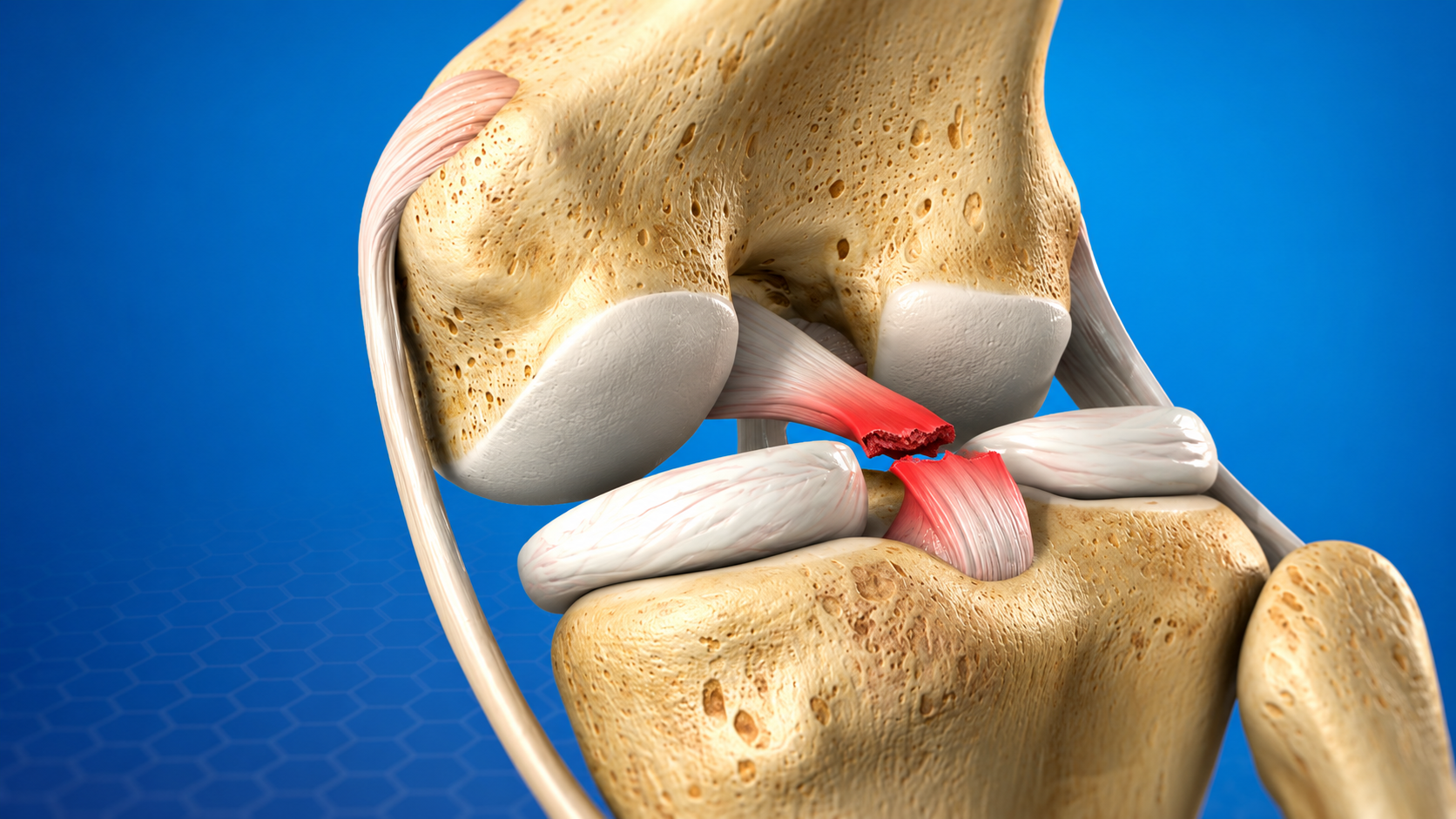 PCL Sprain and Tear Overview